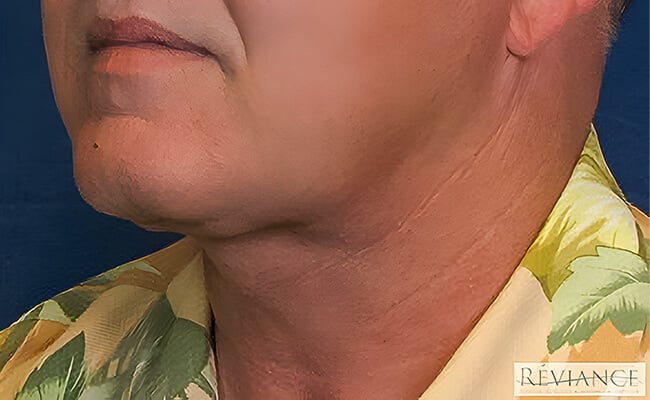 Neck Lift after surgery – Murrieta Facial Plastic Surgery, case 2
