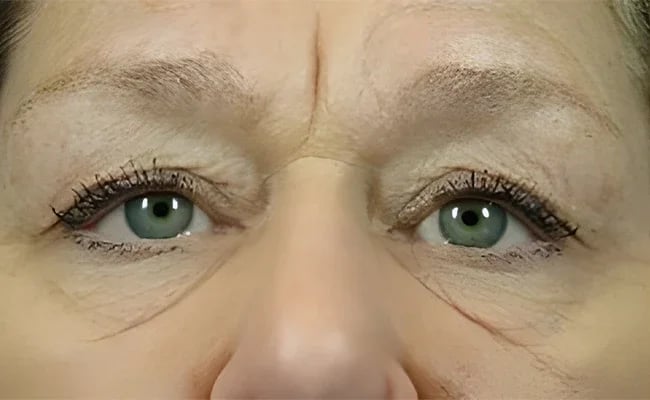 Eyelid Surgery before surgery – Murrieta Facial Plastic Surgery, case 21