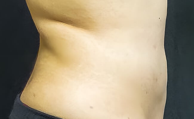 Liposuction after surgery – Murrieta Facial Plastic Surgery, case 8