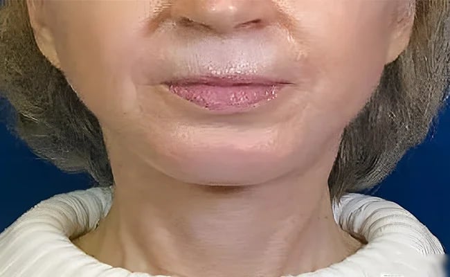 Facelift after surgery – Murrieta Facial Plastic Surgery, case 26