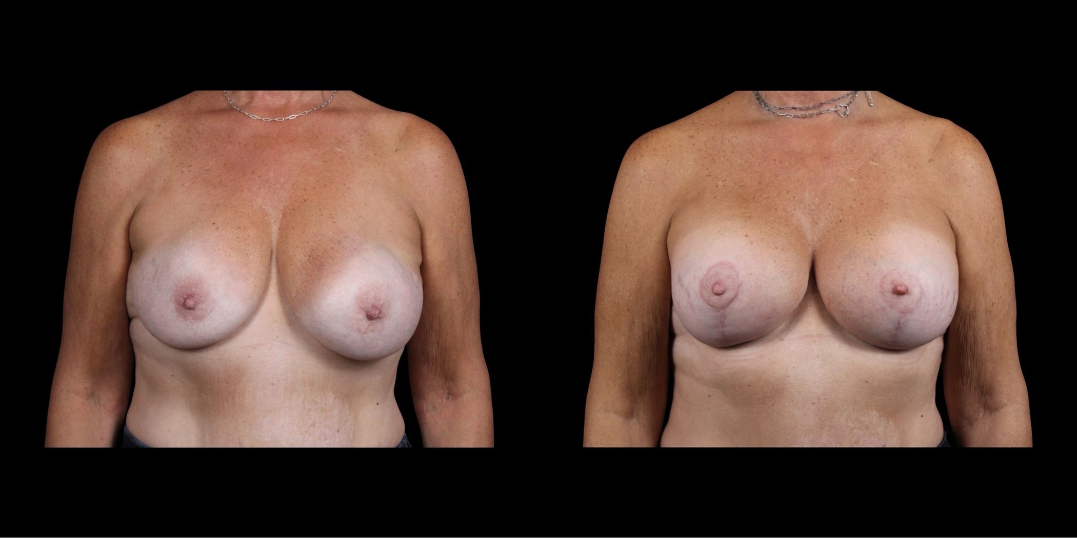 Augmentation Mastopexy before-and-after composite, Consona Plastic Surgery – case 2, view 1
