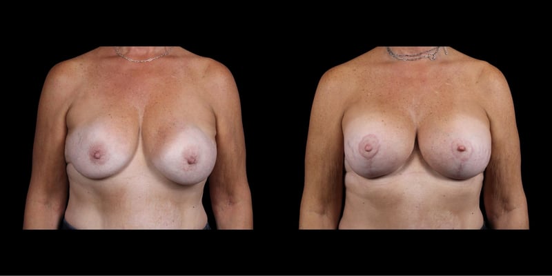 Augmentation Mastopexy before-and-after composite, Consona Plastic Surgery – case 2, view 1