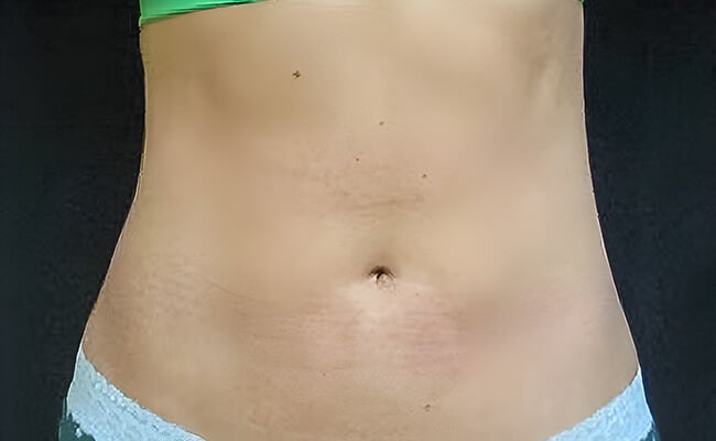 Liposuction after surgery – Murrieta Facial Plastic Surgery, case 3