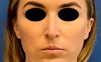 Rhinoplasty before surgery – Murrieta Facial Plastic Surgery, case 1