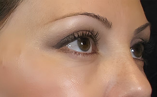 Vampire Facelift before treatment – Murrieta Facial Plastic Surgery, case 3
