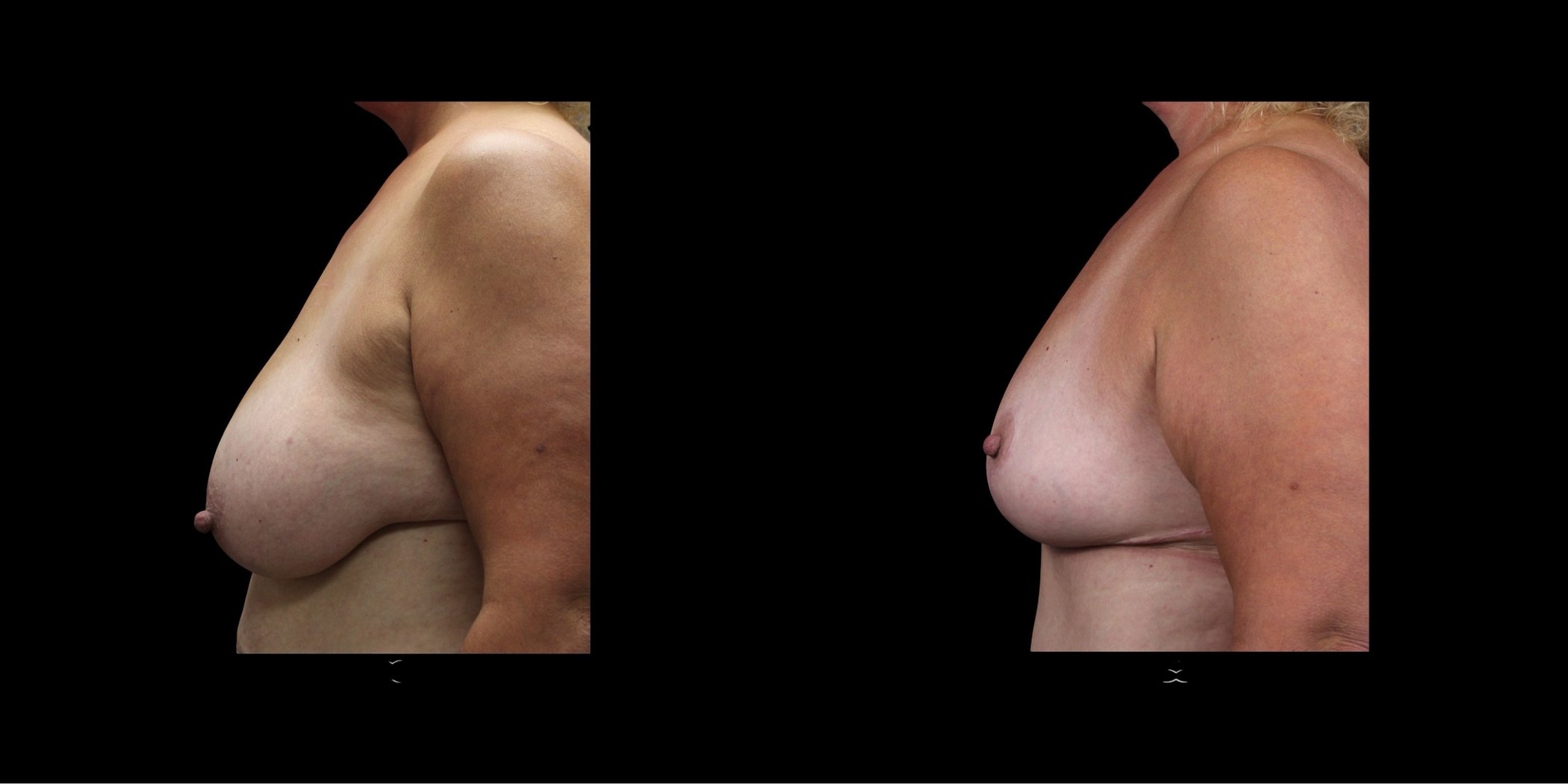 Breast Lift before-and-after composite, Consona Plastic Surgery – case 1, view 2