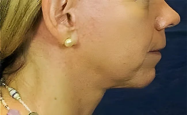 Facelift after surgery – Murrieta Facial Plastic Surgery, case 9