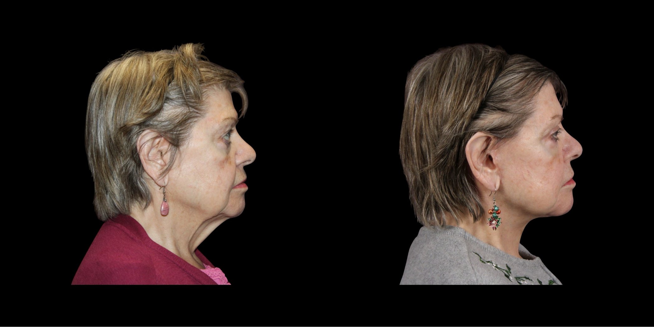 Face & Neck Lift before-and-after composite, Consona Plastic Surgery – case 2, view 3