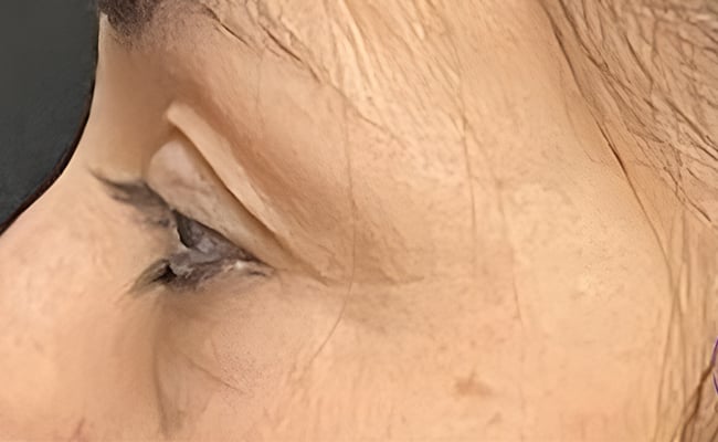 Eyelid Surgery before surgery – Murrieta Facial Plastic Surgery, case 2