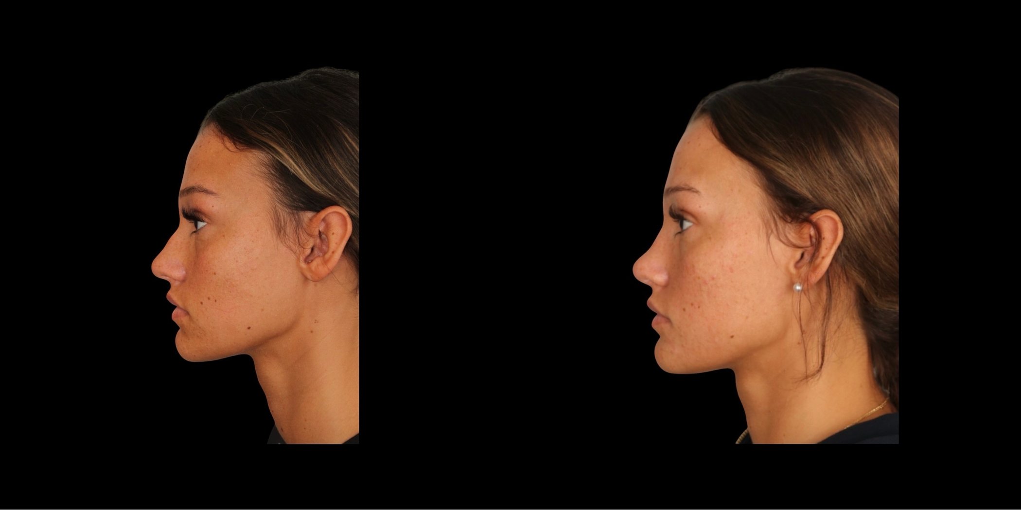Rhinoplasty before-and-after composite, Consona Plastic Surgery – case 4, view 2
