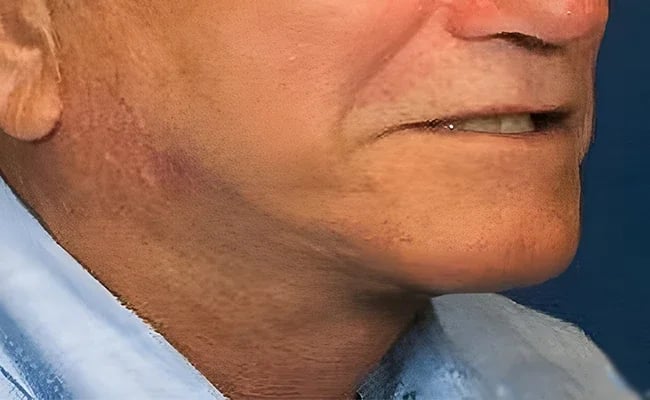 Facelift after surgery – Murrieta Facial Plastic Surgery, case 23