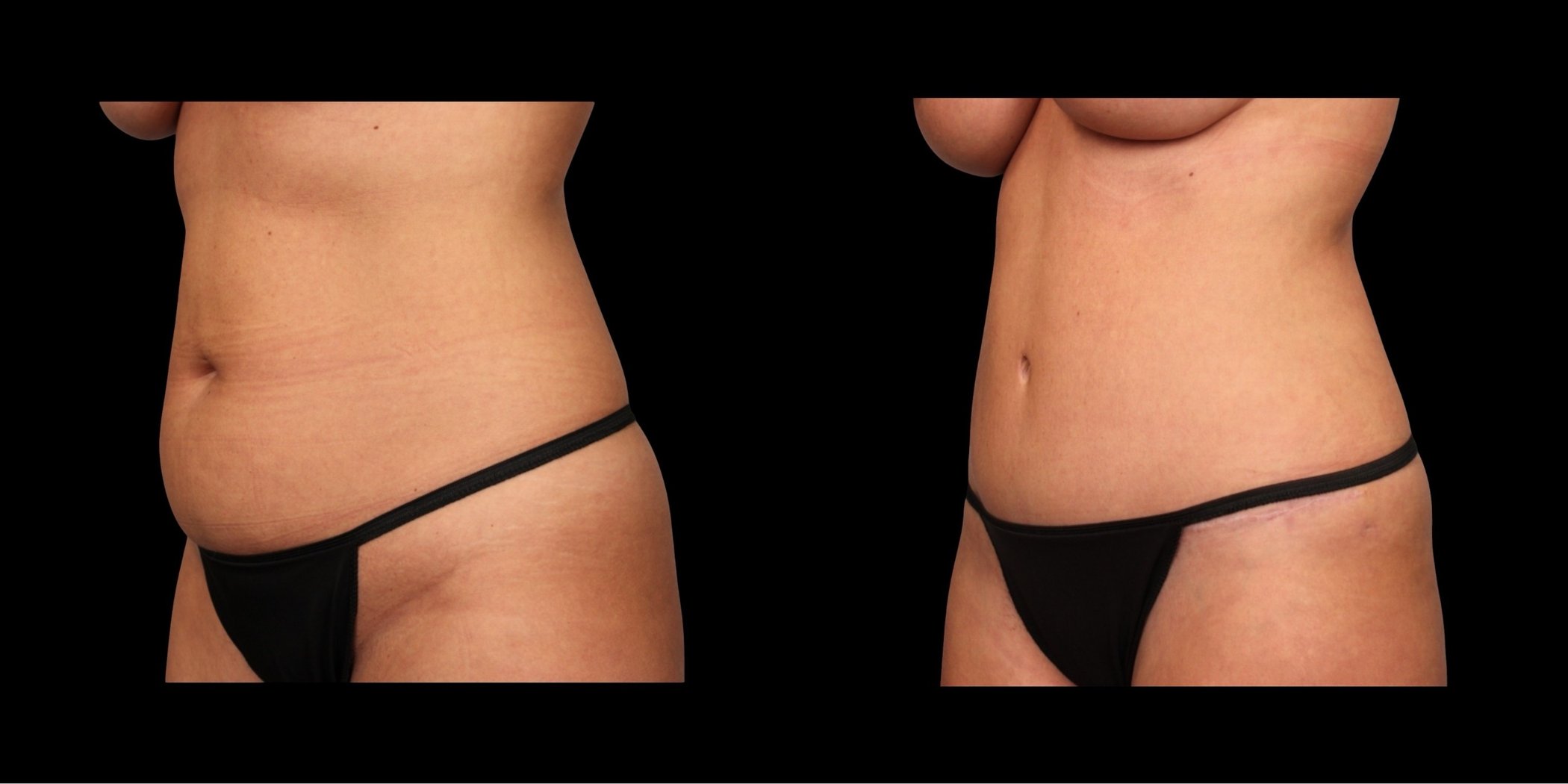 Abdominoplasty before-and-after composite, Consona Plastic Surgery – case 1, view 2