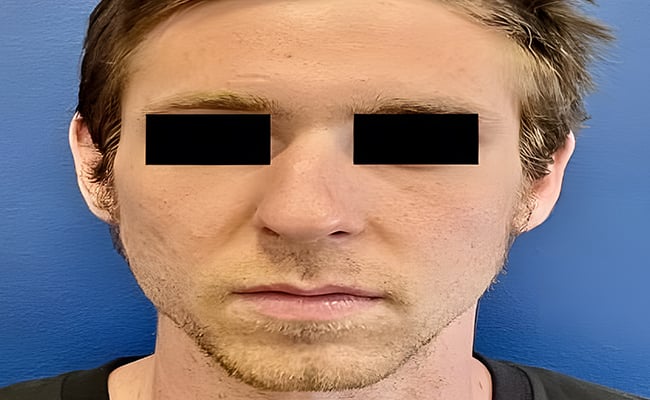 Rhinoplasty before surgery – Murrieta Facial Plastic Surgery, case 15