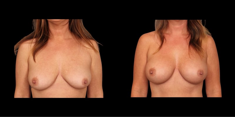 Breast Augmentation before-and-after composite, Consona Plastic Surgery – case 3, view 1