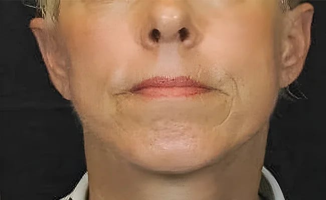 Facelift after surgery – Murrieta Facial Plastic Surgery, case 8