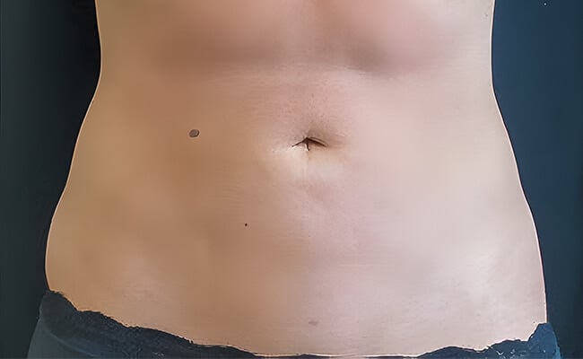 Liposuction after surgery – Murrieta Facial Plastic Surgery, case 6