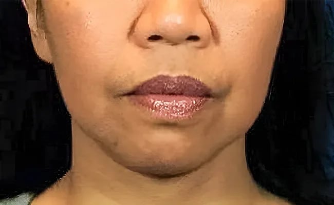 Facelift before surgery – Murrieta Facial Plastic Surgery, case 28