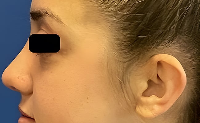 Rhinoplasty after surgery – Murrieta Facial Plastic Surgery, case 9