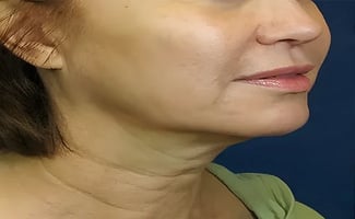 Facelift before surgery – Murrieta Facial Plastic Surgery, case 1