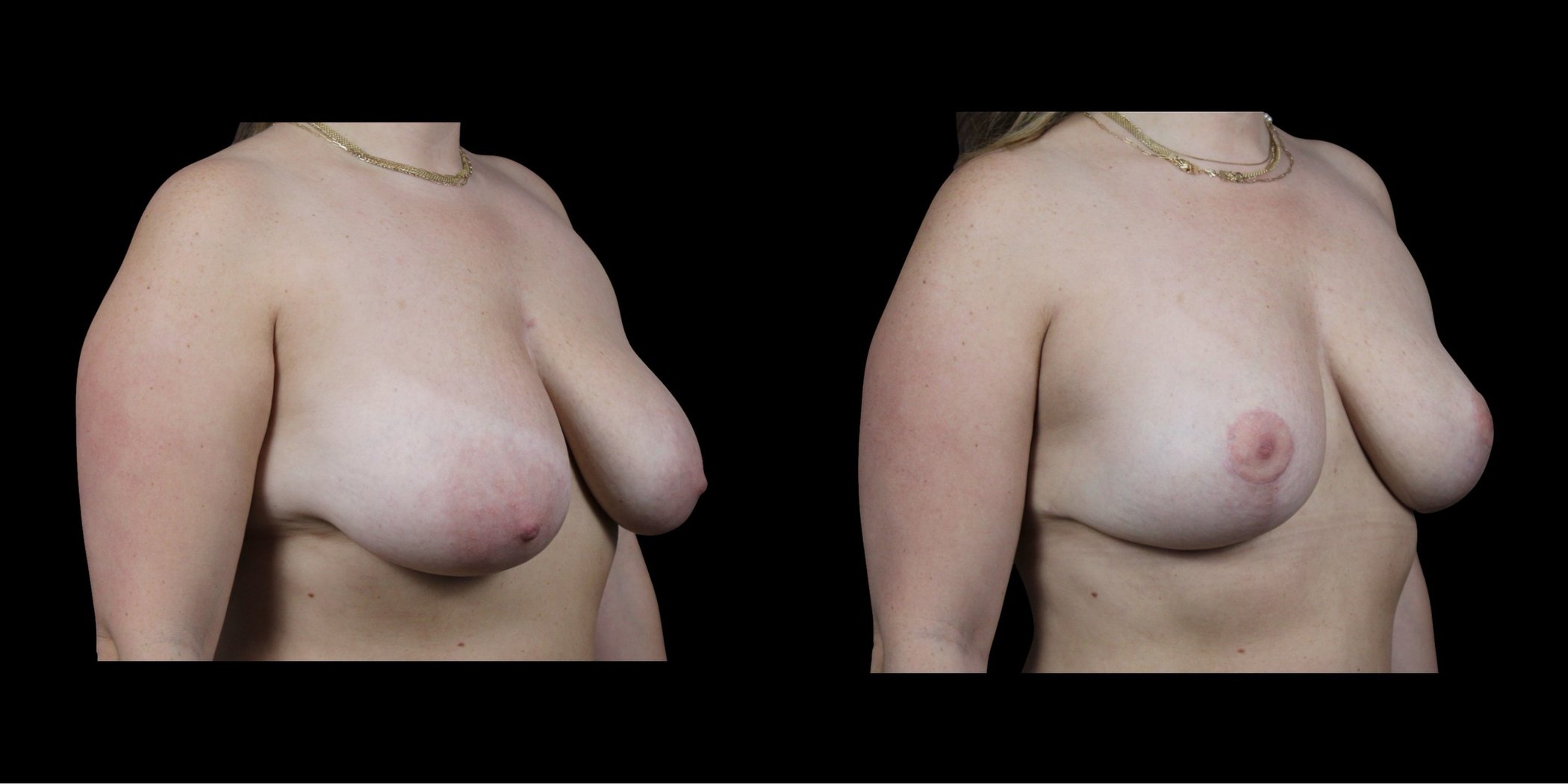 Breast Lift before-and-after composite, Consona Plastic Surgery – case 2, view 2