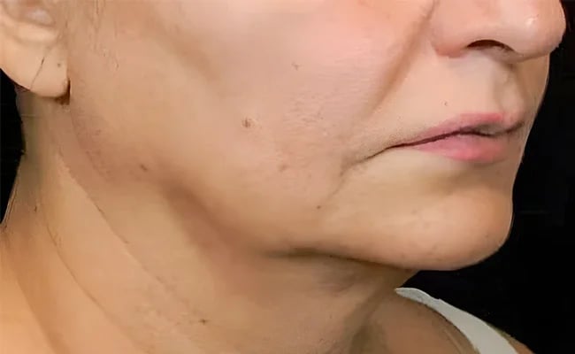 Facelift before surgery – Murrieta Facial Plastic Surgery, case 2