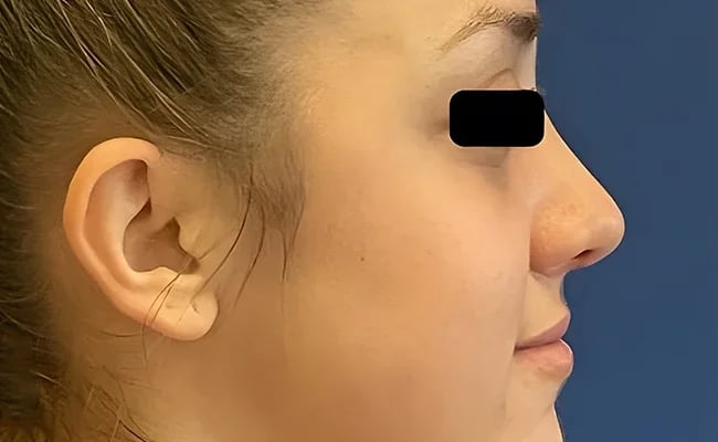 Rhinoplasty after surgery – Murrieta Facial Plastic Surgery, case 10