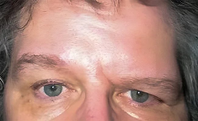Brow Lift before surgery – Murrieta Facial Plastic Surgery, case 2