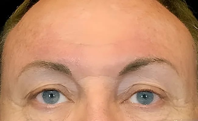 Brow Lift after surgery – Murrieta Facial Plastic Surgery, case 4