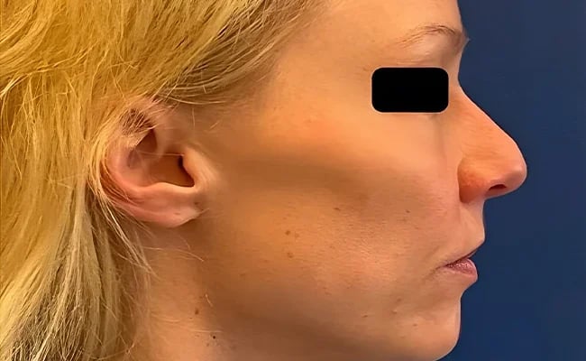 Rhinoplasty before surgery – Murrieta Facial Plastic Surgery, case 6