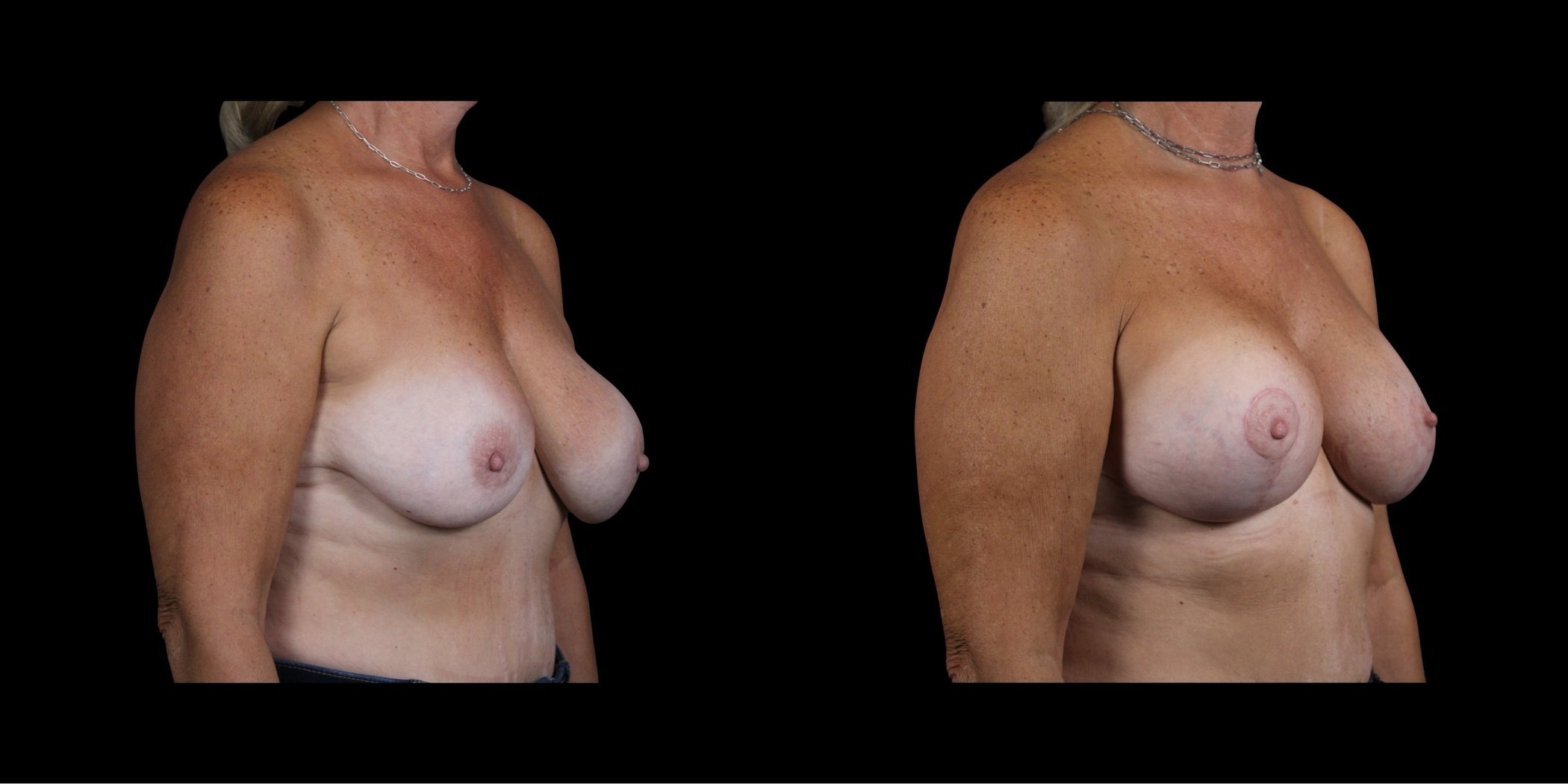 Augmentation Mastopexy before-and-after composite, Consona Plastic Surgery – case 2, view 2
