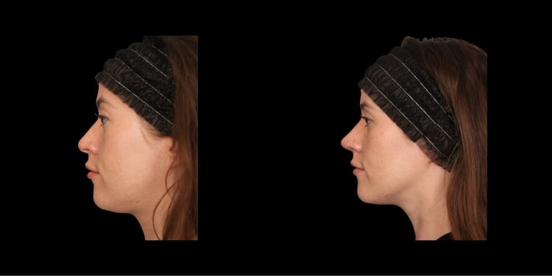 Rhinoplasty before-and-after composite, Consona Plastic Surgery – case 1, view 1