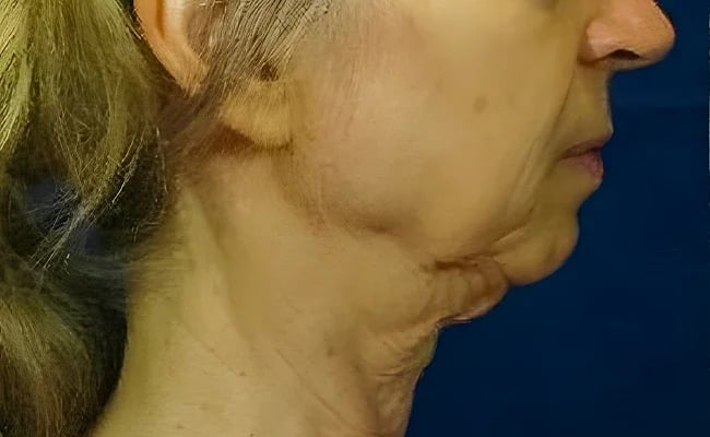 Chin Augmentation before surgery – Murrieta Facial Plastic Surgery, case 3