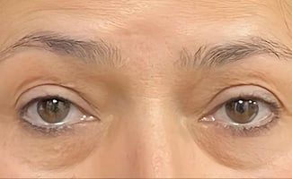 Eyelid Surgery before surgery – Murrieta Facial Plastic Surgery, case 1