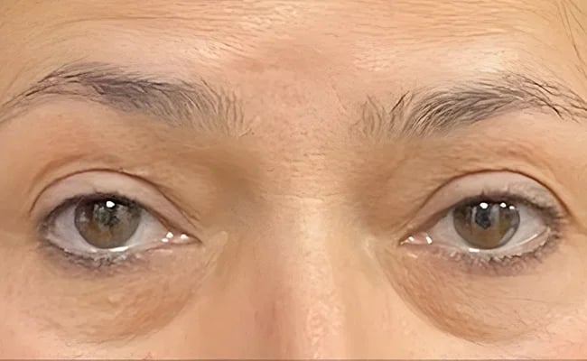 Eyelid Surgery before surgery – Murrieta Facial Plastic Surgery, case 1