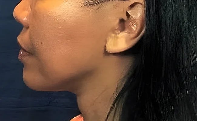 Chin Augmentation after surgery – Murrieta Facial Plastic Surgery, case 4