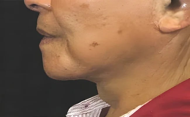 Facelift after surgery – Murrieta Facial Plastic Surgery, case 17