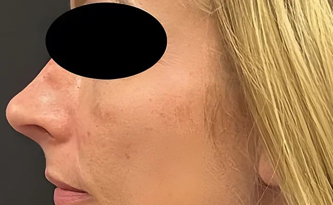Rhinoplasty after surgery – Murrieta Facial Plastic Surgery, case 13