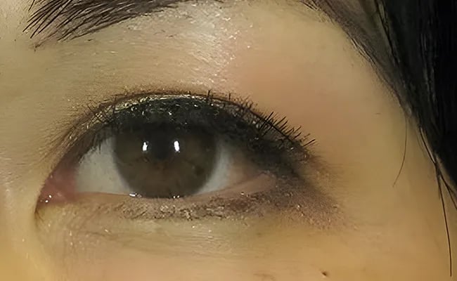 Eyelid Surgery after surgery – Murrieta Facial Plastic Surgery, case 5