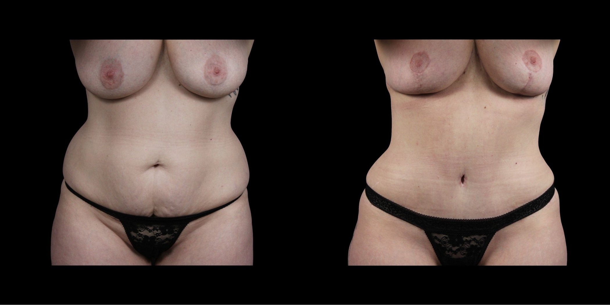 Abdominoplasty before-and-after composite, Consona Plastic Surgery – case 2, view 1
