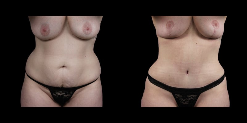 Abdominoplasty before-and-after composite, Consona Plastic Surgery – case 2, view 1