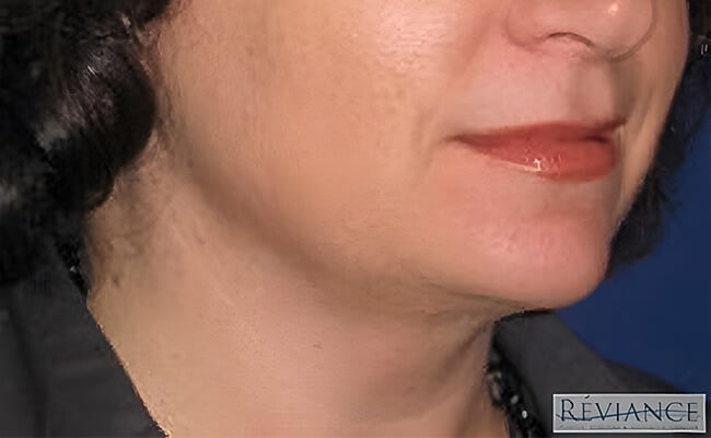 Neck Lift after surgery – Murrieta Facial Plastic Surgery, case 7