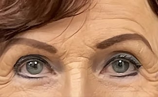 Brow Lift before surgery – Murrieta Facial Plastic Surgery, case 1