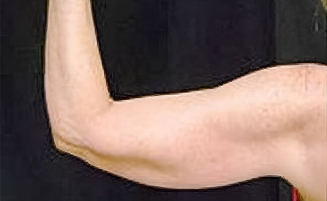 Liposuction before surgery – Murrieta Facial Plastic Surgery, case 2