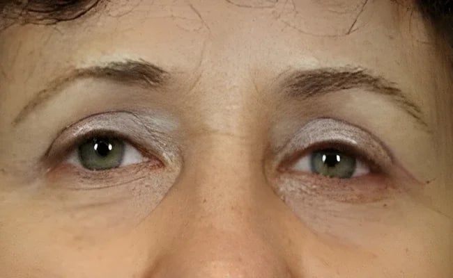 Eyelid Surgery after surgery – Murrieta Facial Plastic Surgery, case 19