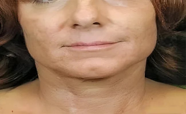 Facelift after surgery – Murrieta Facial Plastic Surgery, case 18