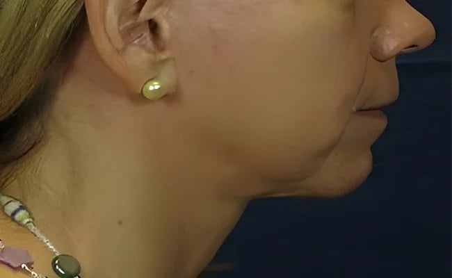 Facelift after surgery – Murrieta Facial Plastic Surgery, case 19