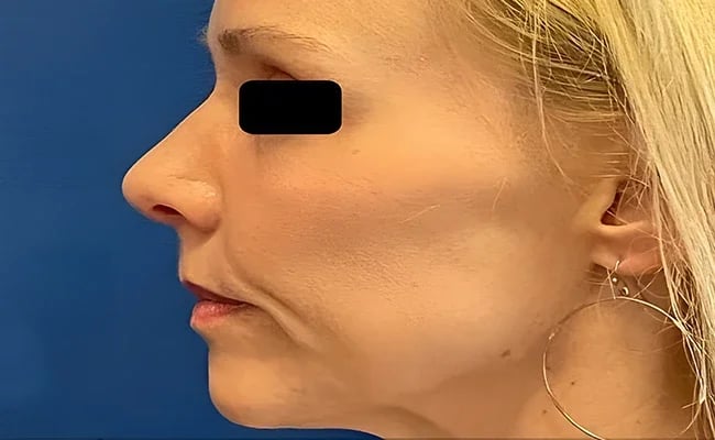 Rhinoplasty after surgery – Murrieta Facial Plastic Surgery, case 7