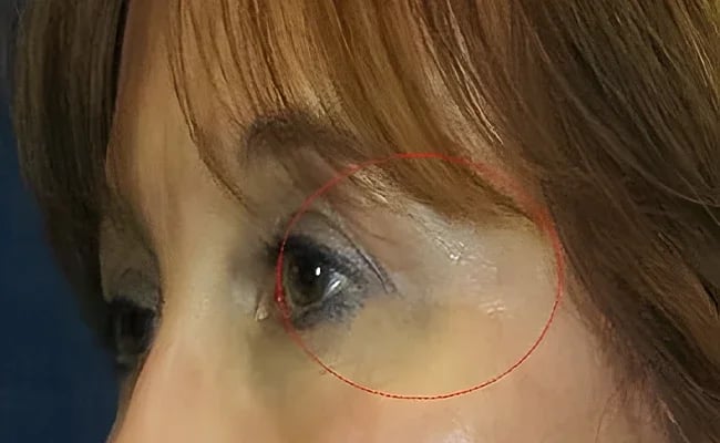 Eyelid Surgery after surgery – Murrieta Facial Plastic Surgery, case 6
