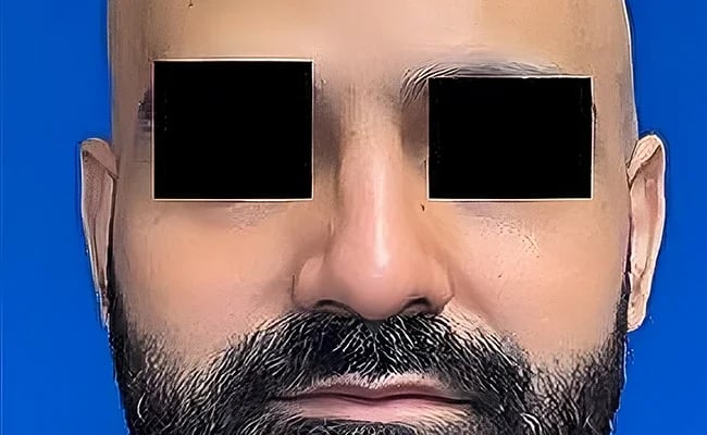 Rhinoplasty after surgery – Murrieta Facial Plastic Surgery, case 17