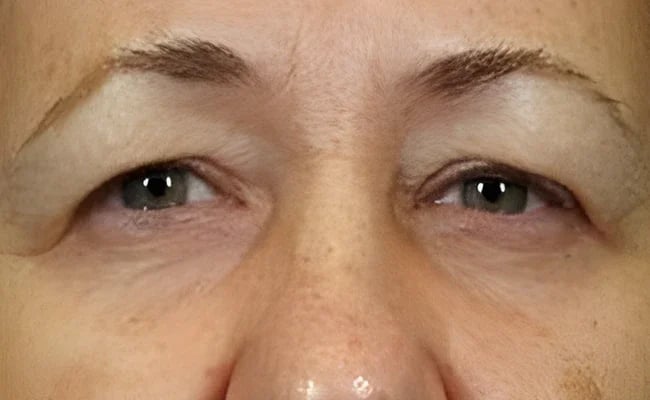 Eyelid Surgery before surgery – Murrieta Facial Plastic Surgery, case 19